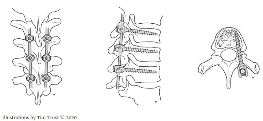 Illustration of a posterior fusion at Gillette Children's