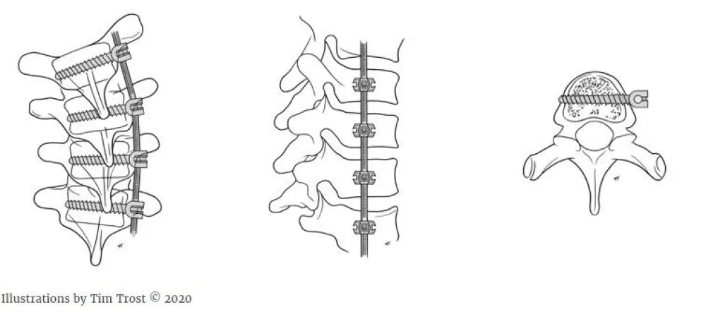 Illustration of Spinal Vertebral Body Tethering at Gillette Children's