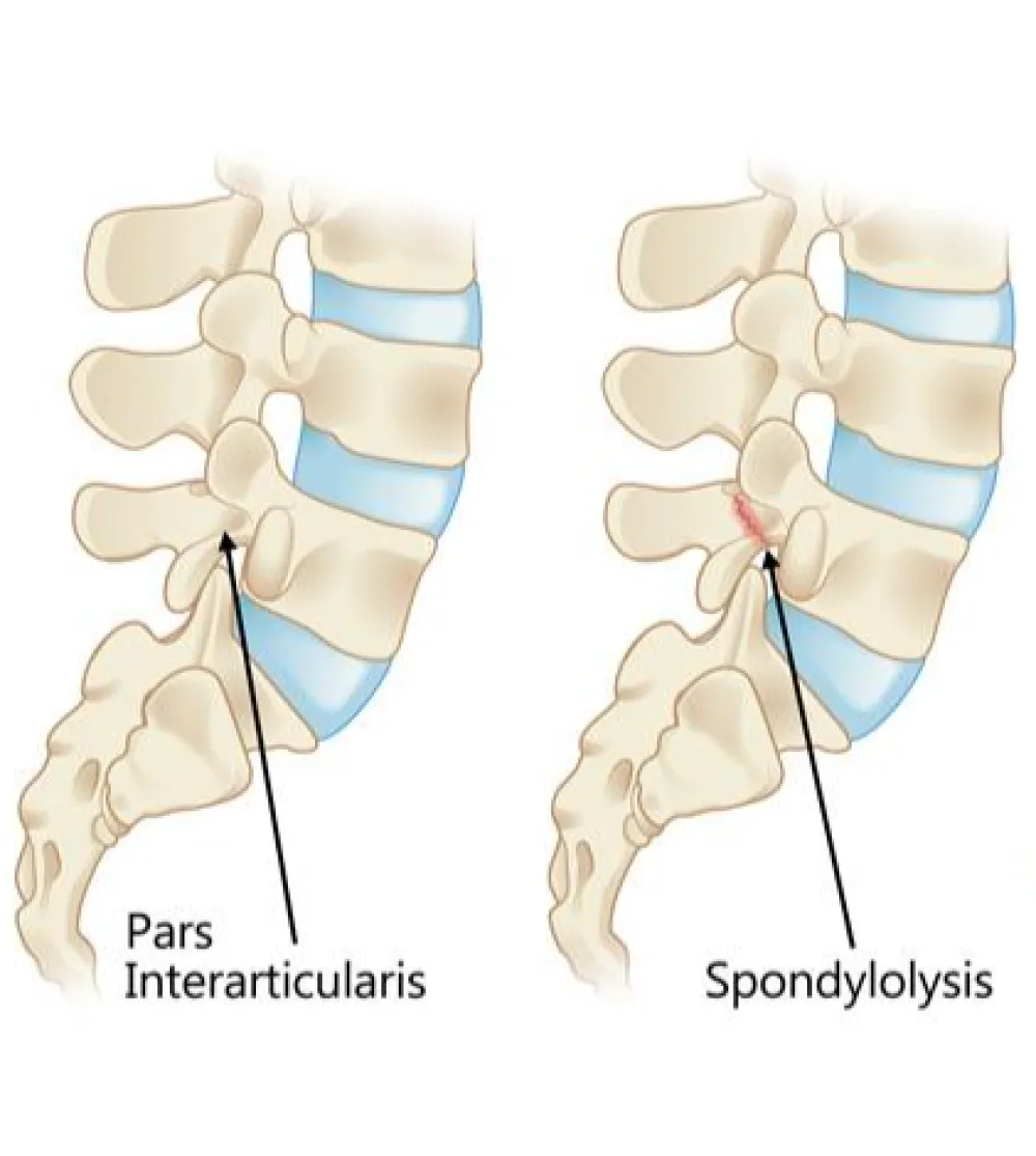 Illustration of spondylolysis