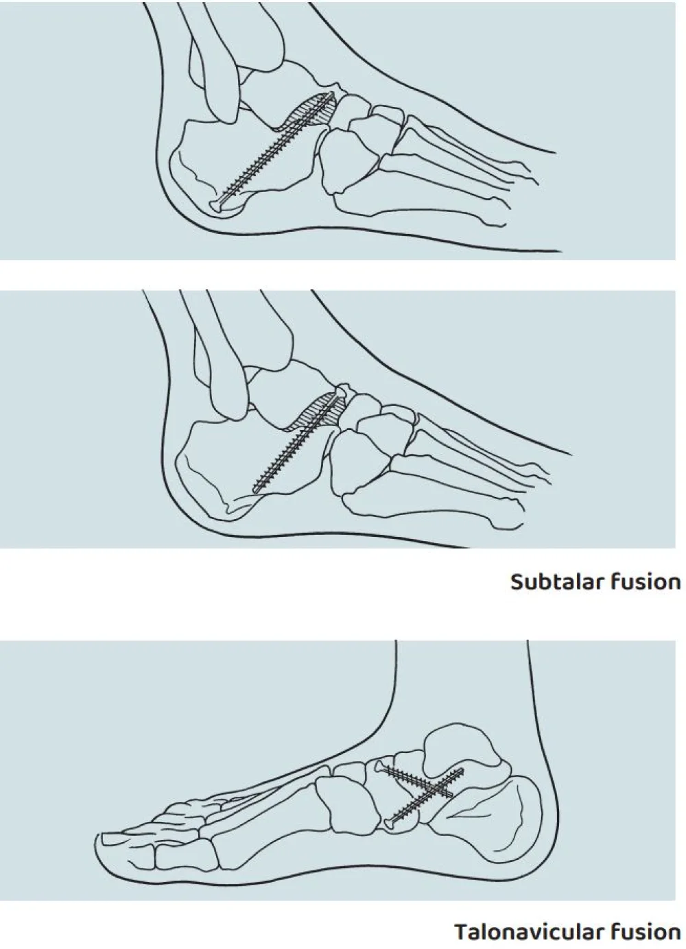 An illustration of a Subtalar or Talonavicular Fusion (Arthrodesis) procedure at Gillette Children's