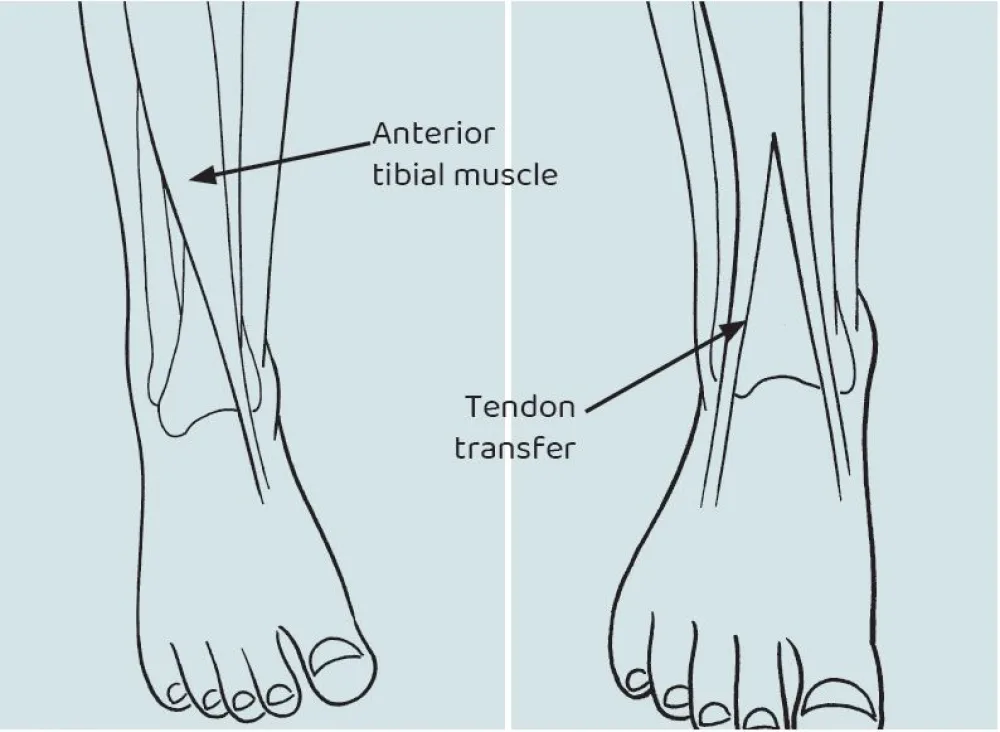 An illustration of the Tibialis Anterior Split Transfer procedure at Gillette Children's