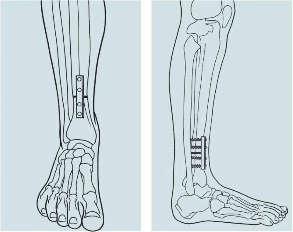 An illustration of a Tibial Derotation Osteotomy procedure at Gillette Children's