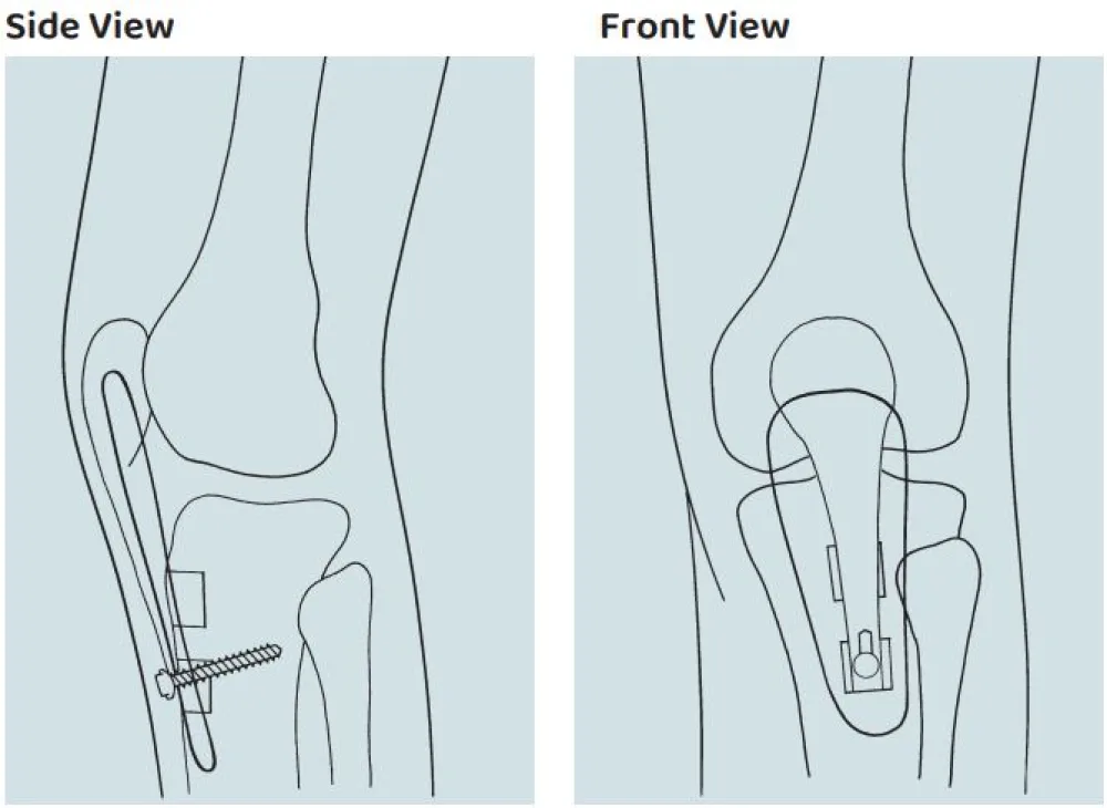 Illustration of a Tibial Tubercle/Patellar Tendon Advancement procedure at Gillette Children's