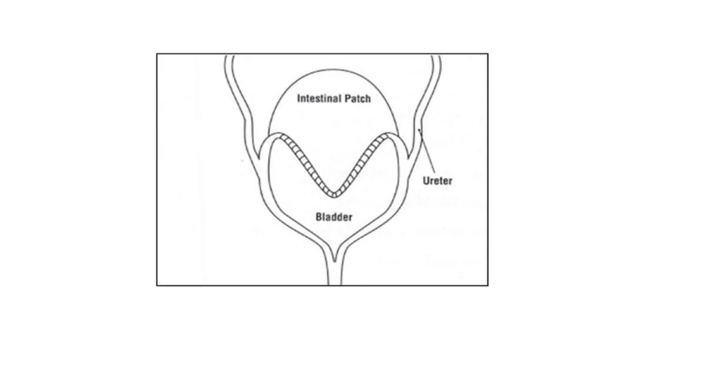 Illustration of bladder augmentation at Gillette Children's