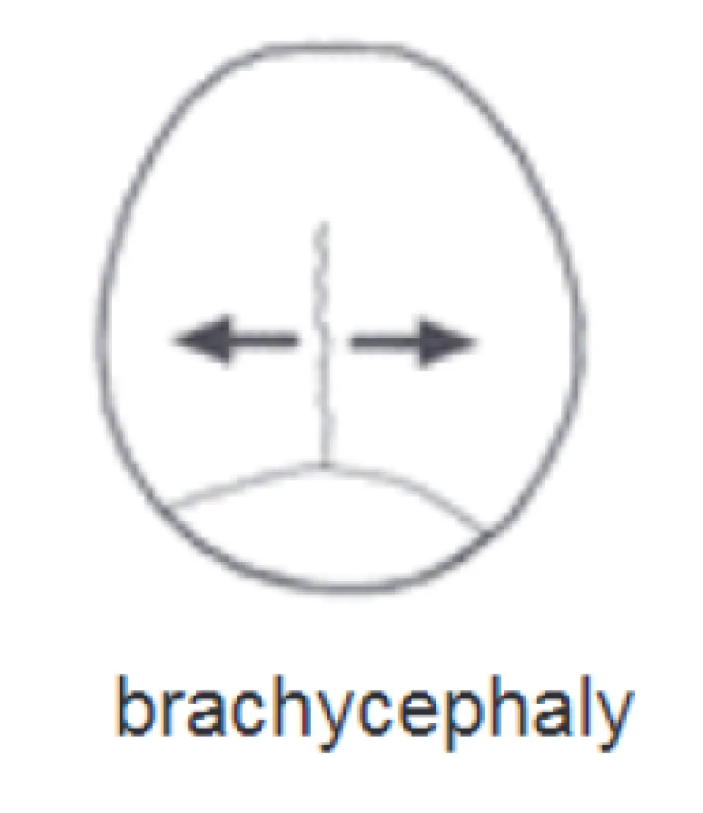 An illustration of brachycephaly at Gillette Children's