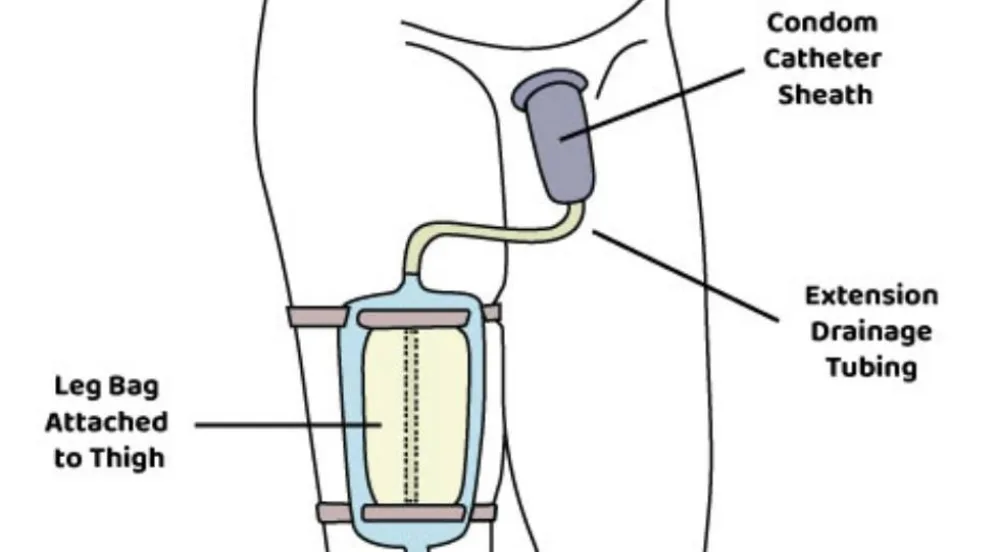 An illustration of a condom catheter.