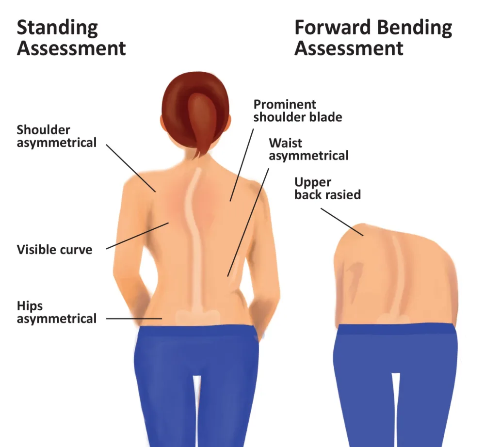 An illustration depicting a Standing Assessment and Forward Bending Assessment at Gillette Children's