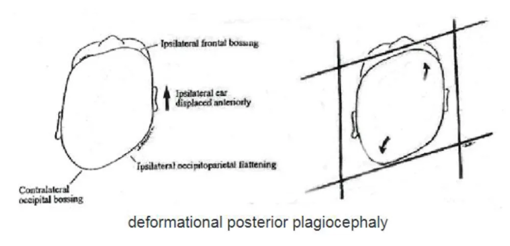 An illustration of deformational posterior plagiocephaly at Gillette Children's