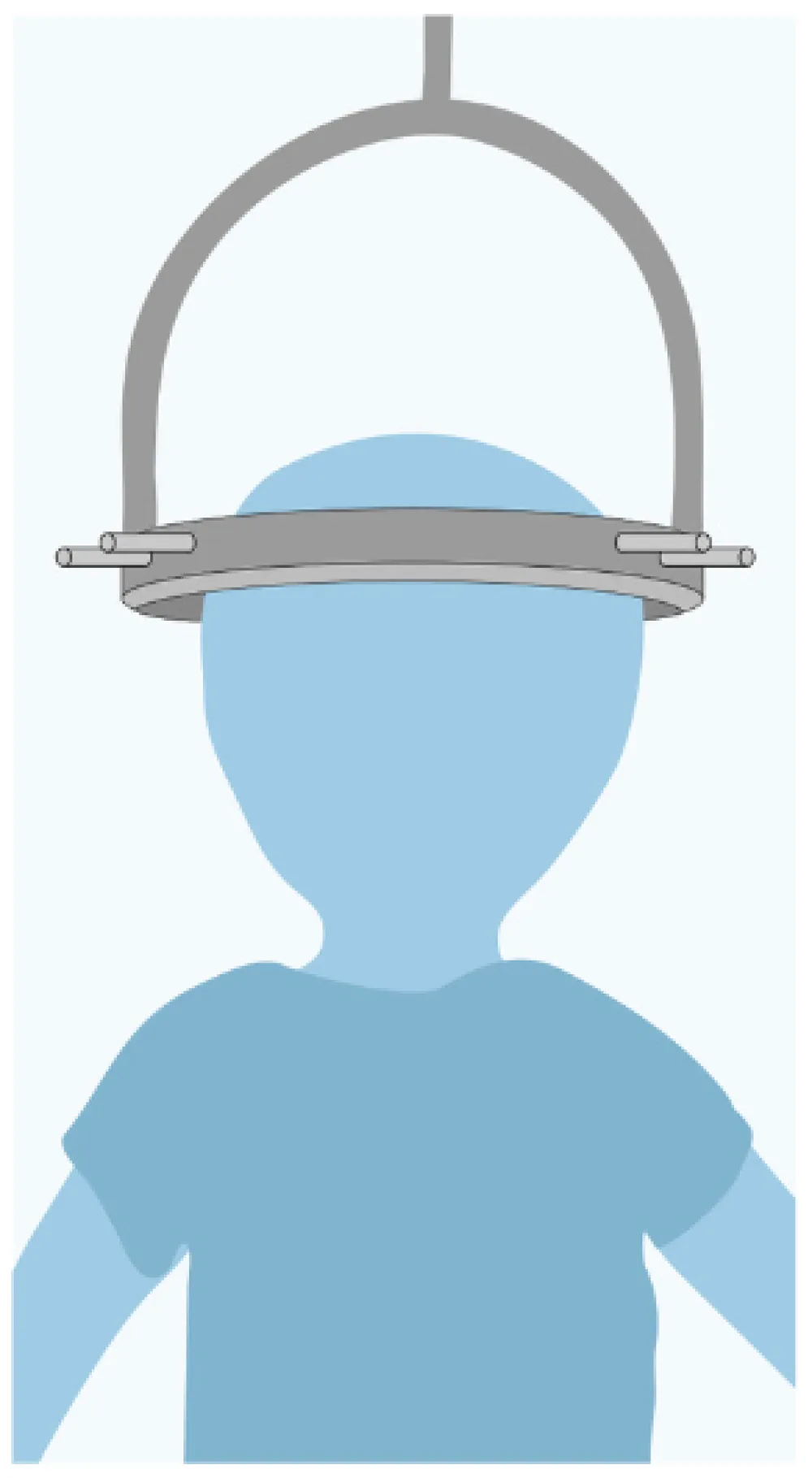 Illustration of someone with halo traction.