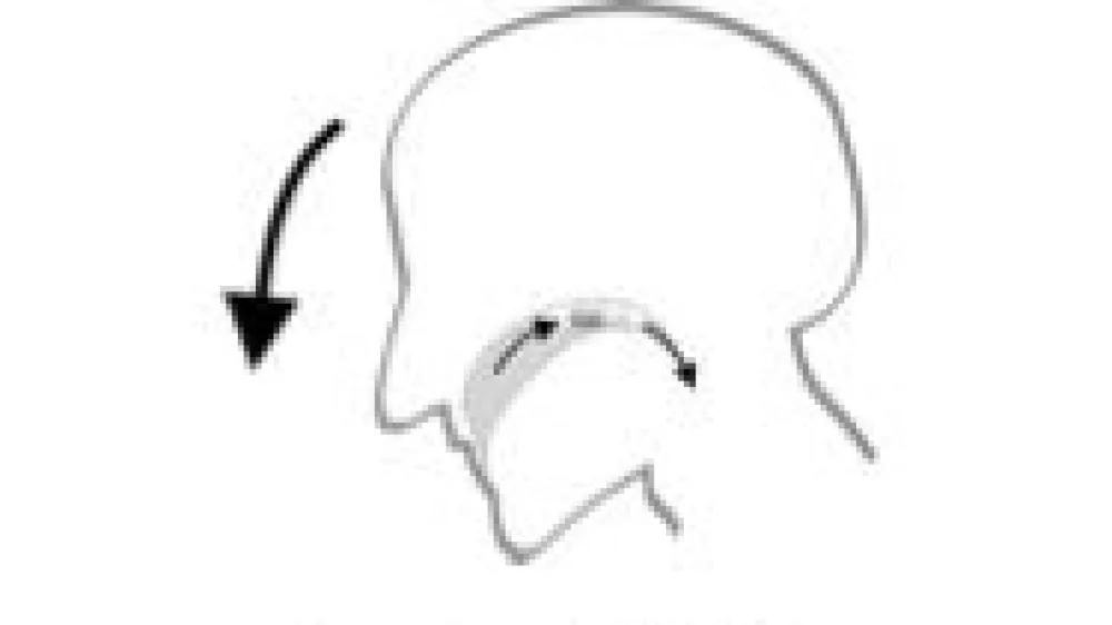 An image of the Lean Forward Method to swallow medication at Gillette Children's