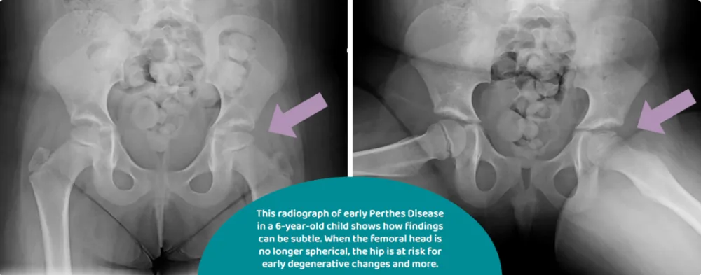 Radiograph of early Perthes Disease.
