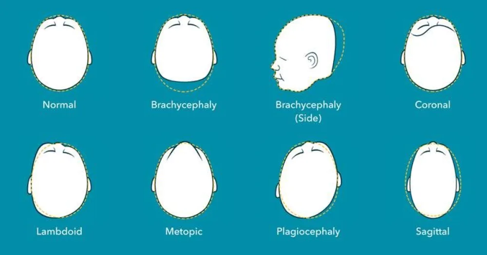 Deformational Plagiocephaly illustration.