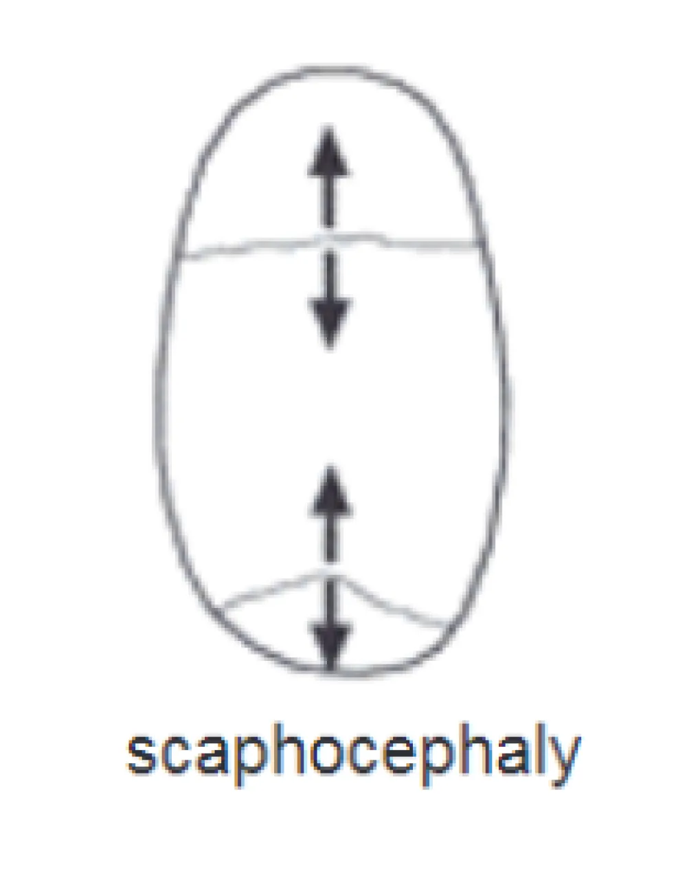 An illustration of scaphocephaly treatment at Gillette Children's
