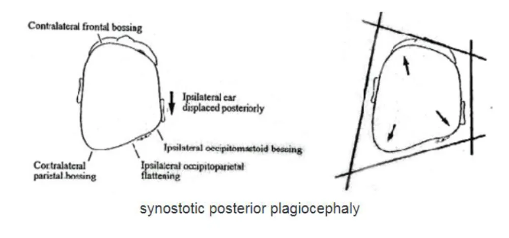 An illustration of synostotic posterior plagiocephaly at Gillette Children's