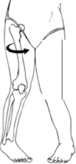 Graphic of the twisted thighbone - Gillette Children's