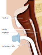 tracheostomy.jpg