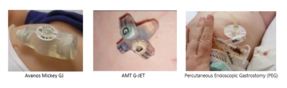 Photograph of Gastrojejunostomy tubes.