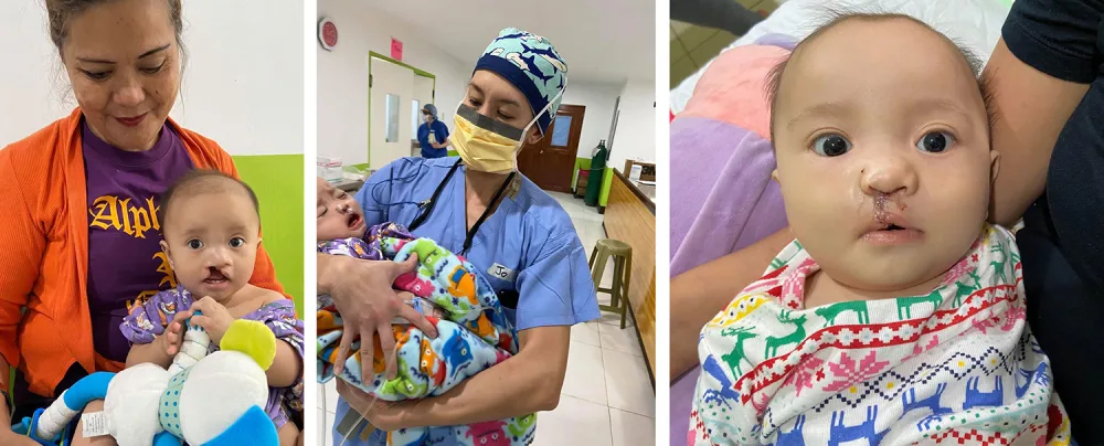 Collage of photos featuring patient with cleft lip.
