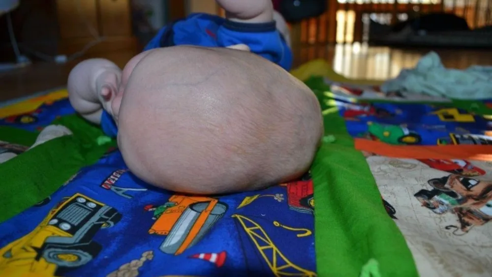 Photo of infant with sagittal craniosynostosis - Gillette Children's.