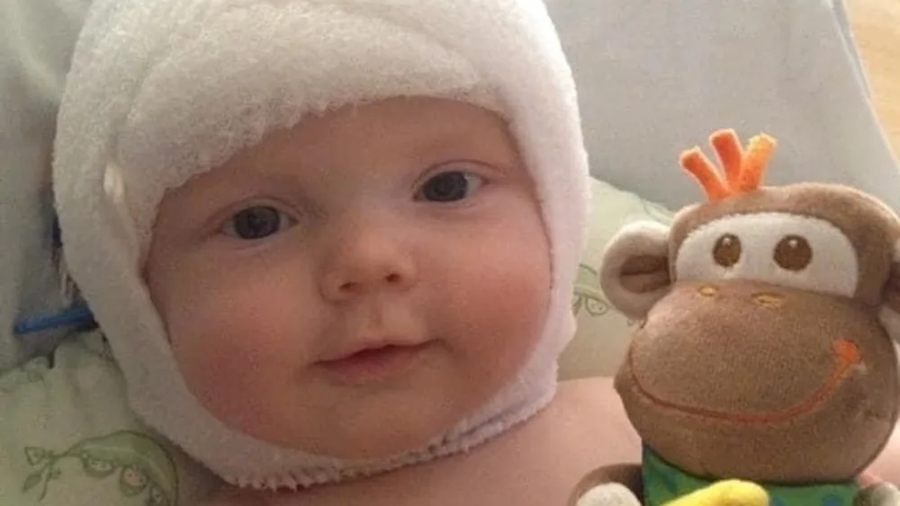 Infant with bandage on head after surgery for craniosynostosis - Gillette Children's.