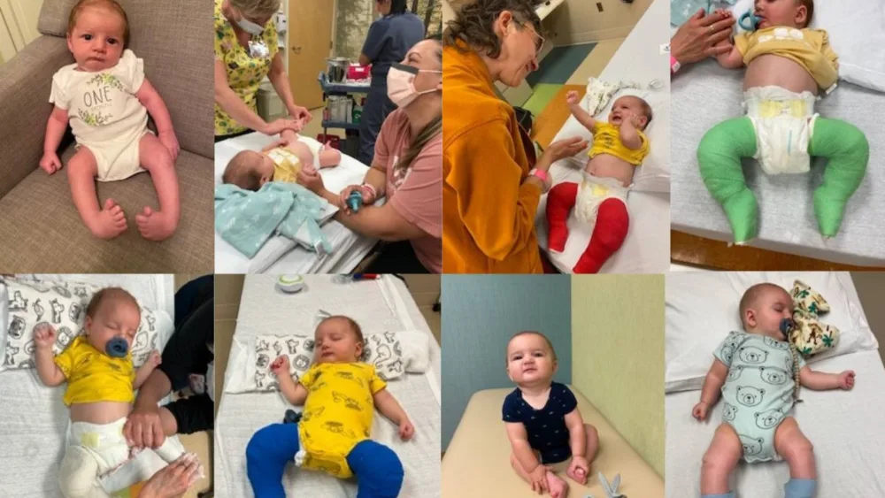 A collage of photos of Wyatt Krentz throughout the clubfoot casting process.