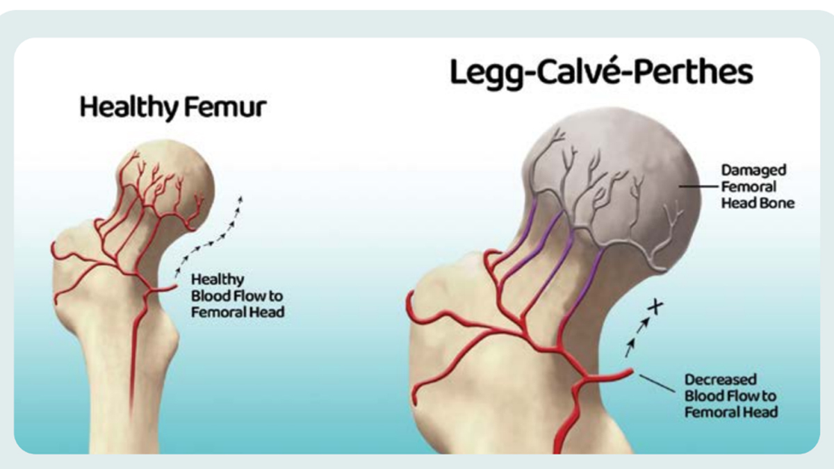 Funding Perthese Disease Research, image size:1200x675