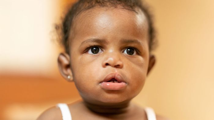 Gillette Children's Two Mothers Cleft Lip Story