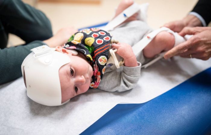 A baby in a corrective helmet is shown on an exam table wearing a Pavlik harness to correct developmental dysplasia of the hip at Gillette Children's.