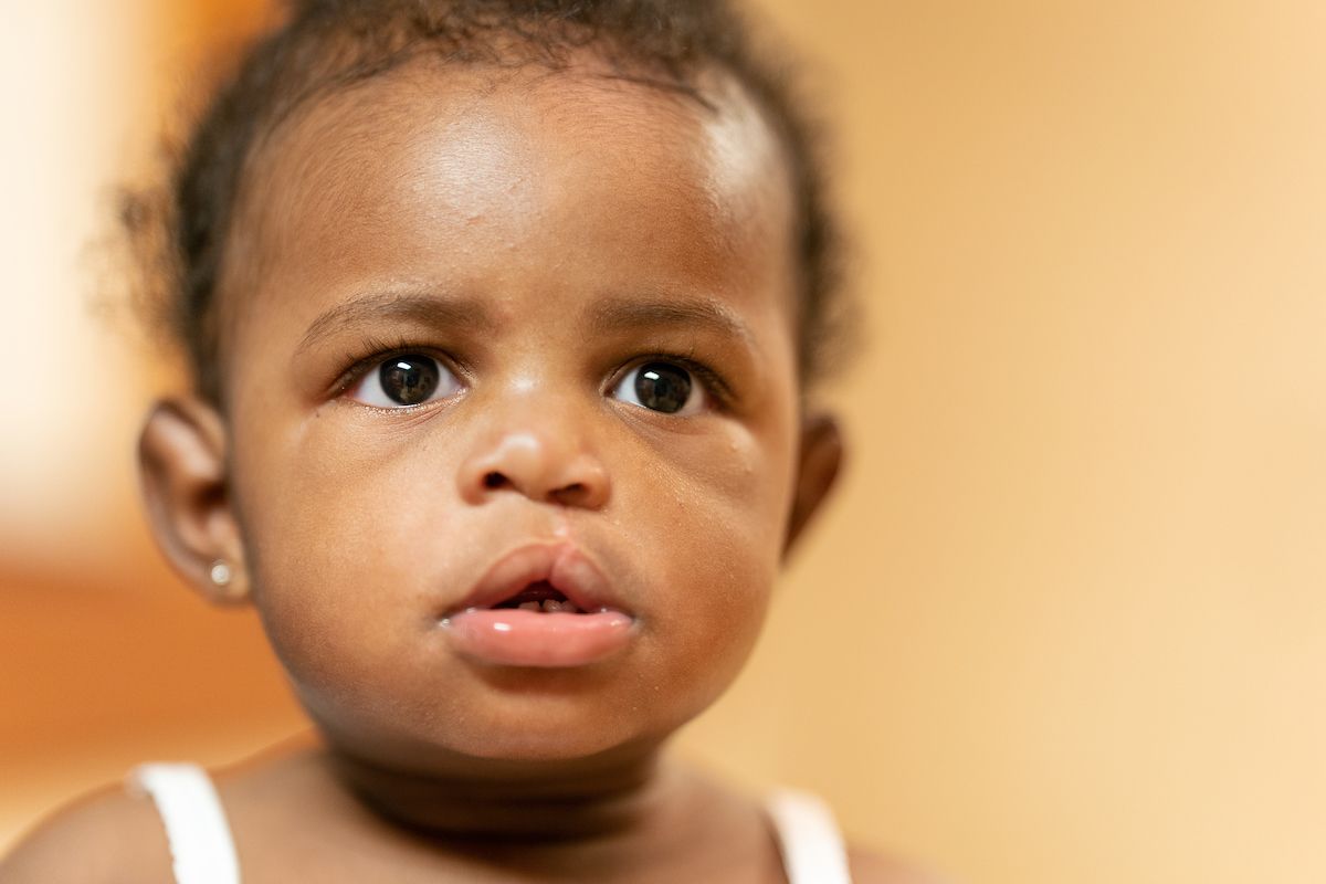 A close-up of baby Heavenly. She had cleft lip repair surgery with Gillette craniofacial and plastic surgeon, Ruth “Jo” Barta, MD.