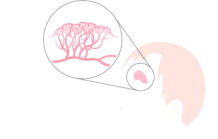An illustration showing the left side of an infant's face with a hemangioma above the left eyebrow, with a detail of what a hemangioma looks like under the surface of the skin.