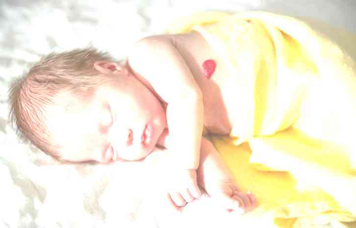 An infant sleeping on their right side facing toward the camera. They are covered to the waist in a yellow blanket and a deep pink vascular malformation is visible on their left side torso.